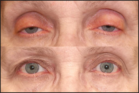 ptosis